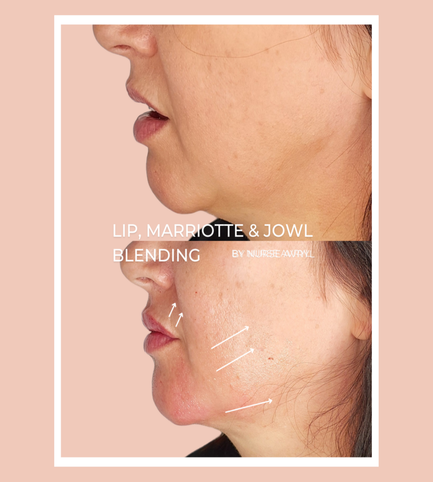 Facial side view with annotations for lip, marriotte, and jowl blending on a pink background.